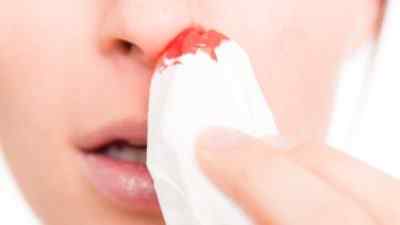 Существующие типы кровотечений из носа