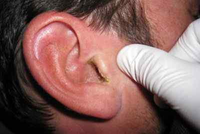 Воспаление наружного ушного канала