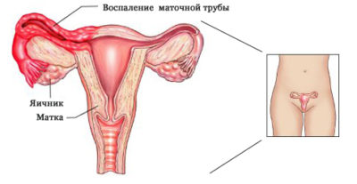 Воспаление матки, маточных труб и яичников