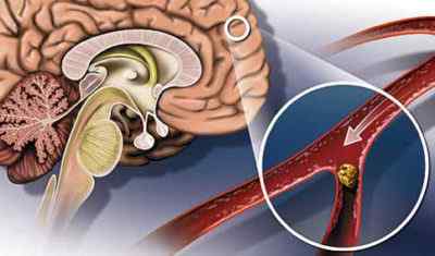 Атеросклероз сосудов шеи и головного мозга. Повышенное артериальное давление